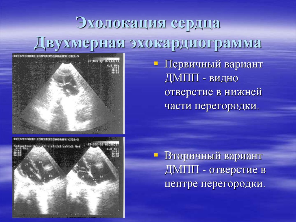 Эхолокация. Эхолокация сердца. Эхолокация у человека. Ультразвуковая эхолокация.