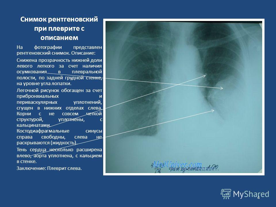 Описание рентген снимка. Двусторонний плеврит рентген. Плеврит на рентгене описание снимка. Плеврит рентген описание. Рентген снимок при плеврите.