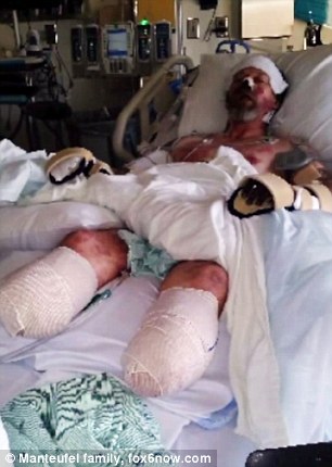 Greg was told the infection was likely transmitted via a lick from his own dog. Pictured: Greg with his amputated legs and his hands before they were amputated