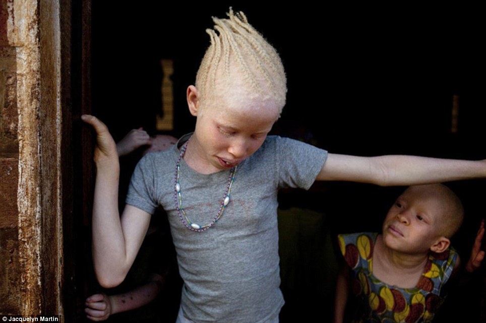 Альбинизмом страдают. Афроамериканец альбинос.