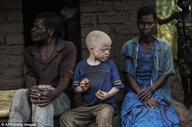 An albino boy sits between his two parents at their home in Malawi. At least six albinos have been killed in Malawi since a surge in attacks which began in December 2014, although UN agencies put the figure at nine