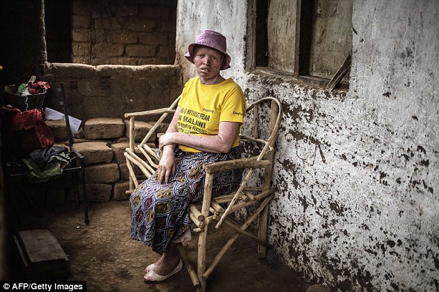 Femia Tchulani, 42, lives in constant fear of attackers who target and kill albinos in order to sell their body parts on the black market